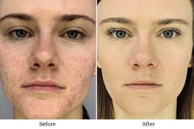 facialesthetics_microneedling