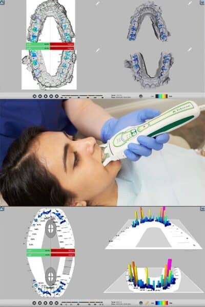 preventativecare_DigitalOcclusalAnalysis