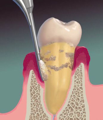 preventativecare_deepcleaning