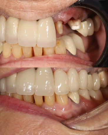 restorative_dentistry_bridges