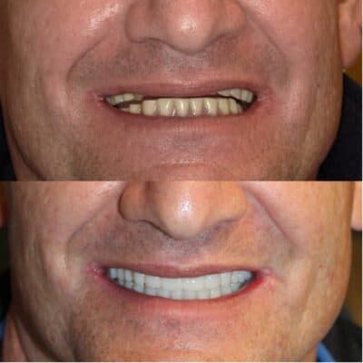 restorative_dentistry_dentures