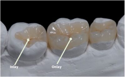 restorative_dentistry_inlay_onlay