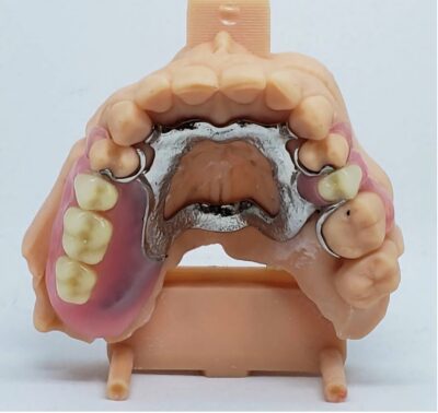 restorative_dentistry_partialdentures