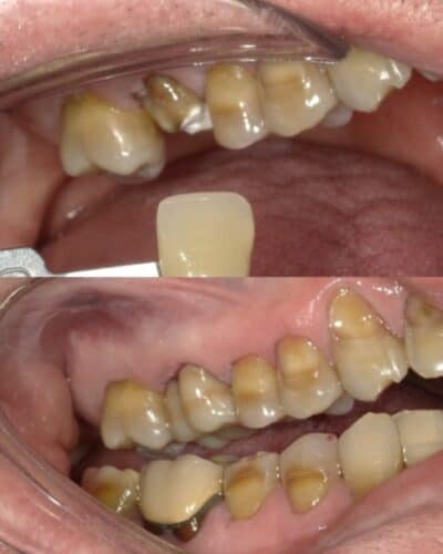 restorative_dentistry_samedaycrown