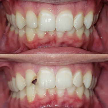 restorative_dentistry_toothcoloredfillings